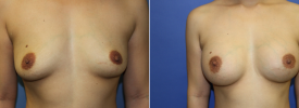 breast-augmentation-p19-1
