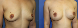 breast-augmentation-p19-2