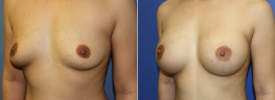 breast-augmentation-p19-3
