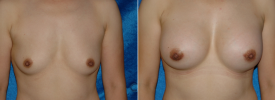breast-augmentation-p2-1