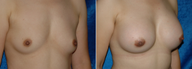 breast-augmentation-p2-2