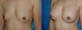 breast-augmentation-p2-3