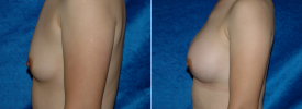breast-augmentation-p2-4