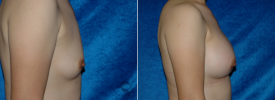 breast-augmentation-p2-5