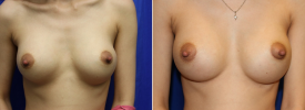 breast-augmentation-p20
