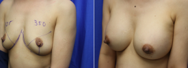 breast-augmentation-p21-3