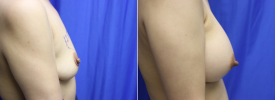 breast-augmentation-p21-4