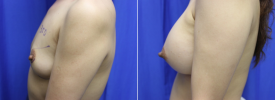 breast-augmentation-p21-5