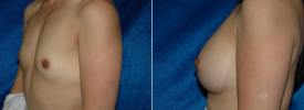 breast-augmentation-p3-2