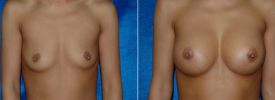 breast-augmentation-p4-1