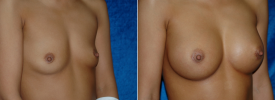 breast-augmentation-p4-2