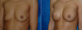 breast-augmentation-p4-3