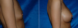 breast-augmentation-p4-4