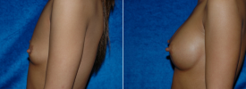 breast-augmentation-p4-5