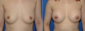 breast-augmentation-p5-1