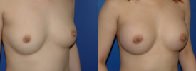 breast-augmentation-p5-2