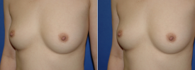 breast-augmentation-p5-3