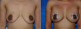 breast-augmentation-p6-1