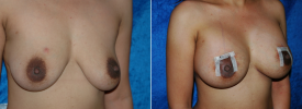 breast-augmentation-p6-2