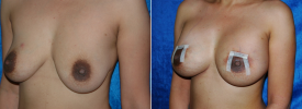 breast-augmentation-p6-3