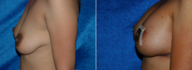 breast-augmentation-p6-4