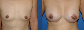breast-augmentation-p7-1
