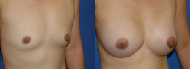 breast-augmentation-p7-2