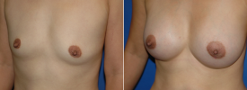breast-augmentation-p7-3