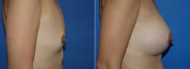 breast-augmentation-p7-4