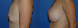 breast-augmentation-p7-5