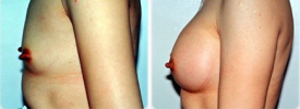 breast-augmentation-p8