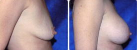 breast-augmentation-p9