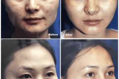 01_cheek_reduction