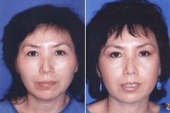02_cheek_reduction