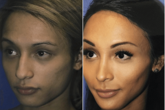 03_cheek_implants