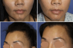 03_cheek_reduction