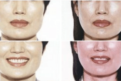 04_cheek_reduction