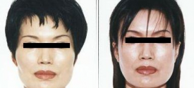 cheek-reduction-p1-1