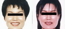 cheek-reduction-p1-2