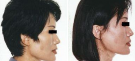 cheek-reduction-p1-3