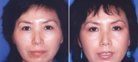 cheek-reduction-p2-1