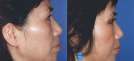 cheek-reduction-p2-2