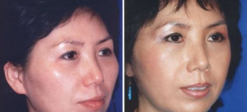 cheek-reduction-p2-3
