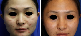 cheek-reduction-p3-1