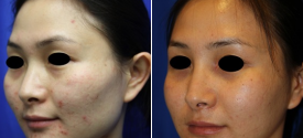 cheek-reduction-p3-2
