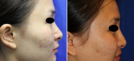 cheek-reduction-p3-3