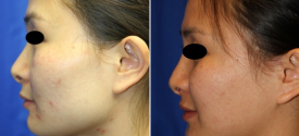 cheek-reduction-p3-4