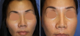 cheek-reduction-p4-1