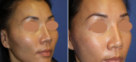 cheek-reduction-p4-2