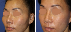 cheek-reduction-p4-3